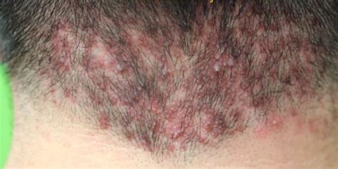 Rash On Back Of Head