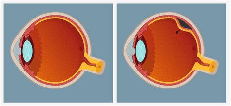 Retinal Detachment Treatment