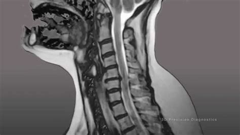 3D Precision Diagnostics: Cervical Spine Injuries MRI - YouTube