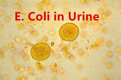 E. Coli in Urine: Causes, Symptoms, and Treatment