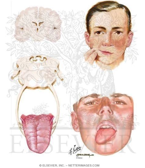 Hypoglossal Nerve (CN-XII)