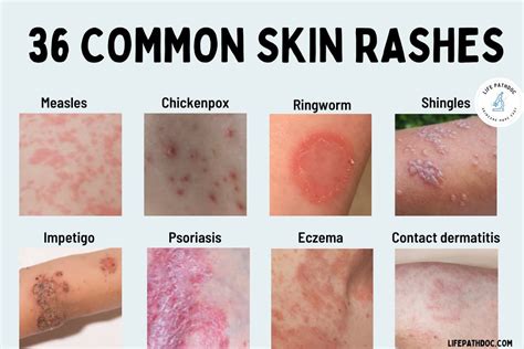 Rash: 36 Common Skin Rashes, Pictures, Causes & Treatment