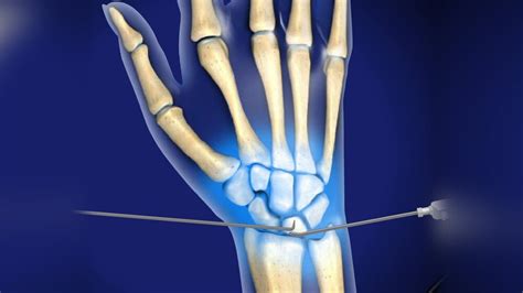 Wrist Arthroscopy | Aptiva Health