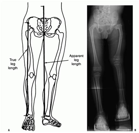 Scanogram Leg Length Discrepancy