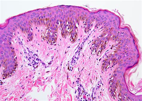 Pathology Outlines - Nevus spilus