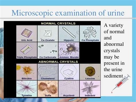 urine examination microscopically - Yahoo Image Search Results | Urinal ...