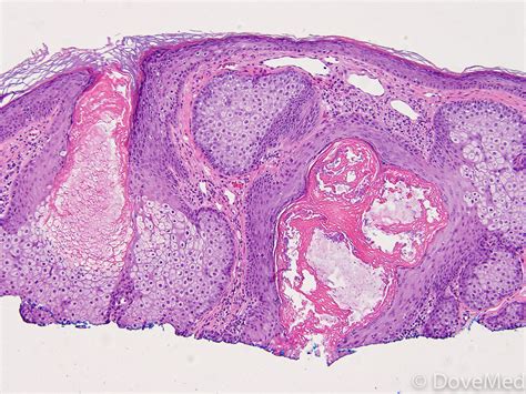 Sebaceous Hyperplasia