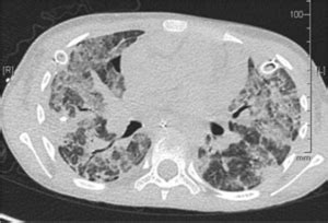 Human Metapneumovirus - microbewiki