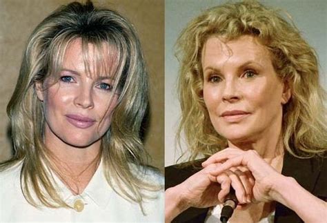 Kim Basinger before and after plastic surgery 10 – Celebrity plastic ...