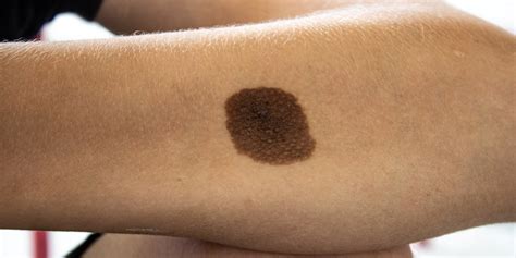 What Is Melanocytic Nevus And How To Treat It?