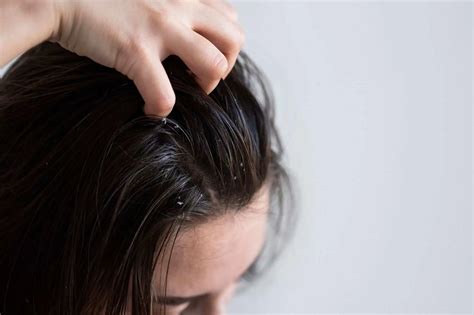 Severe Dandruff Treatment in Riyadh, Jeddah, Saudi Arabia-ERC