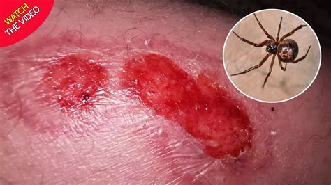 False widow spider bite explodes with pus after dad pops blister with ...