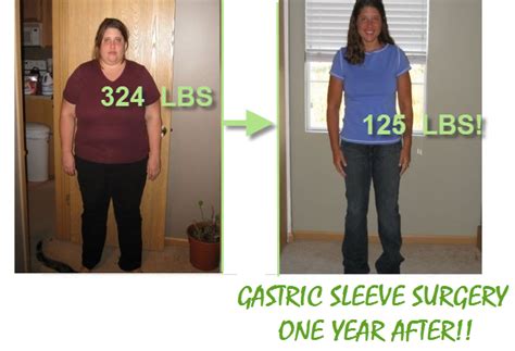 Gastric Sleeve Surgery before and after pictures | Gastric Sleeve