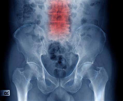 Grade 1 Spondylolisthesis: Causes, Treatments, Recovery