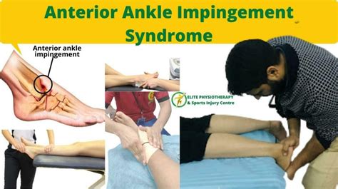 Anterior Ankle Impingement Syndrome