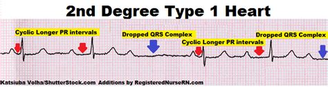 How to tell the Difference Between AV Heart Blocks 1 Degree, Wenckebach, Mobitz II, Third Degree