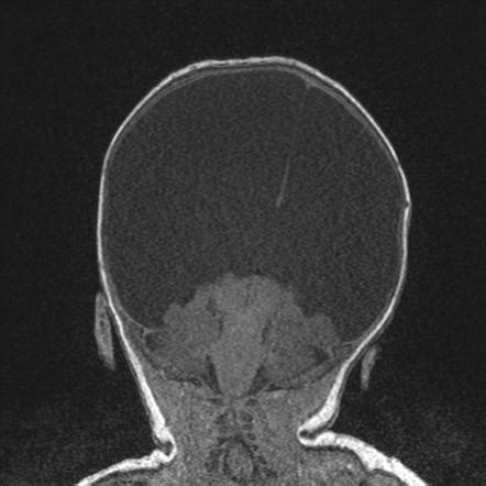 Hydranencephaly | Image | Radiopaedia.org