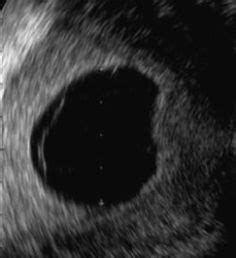 Blighted Ovum on Pinterest | Miscarriage, 12 Weeks and Ultrasound