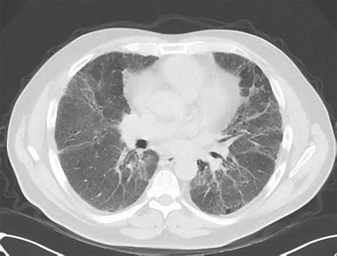 Hypersensitivity pneumonitis causes, symptoms, diagnosis, treatment & prognosis