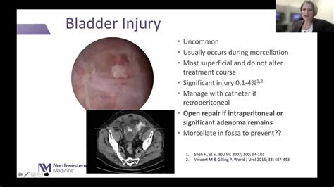 “Holmium Laser Enucleation of the Prostate (HOLEP) for BPH”