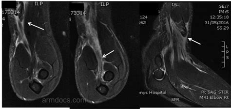 Distal Biceps Tendon Tear MRI