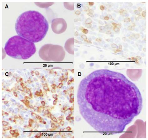 Reports | Free Full-Text | Clonal Evolution of B-Cell Acute Lymphoblastic Leukemia with del(9 ...