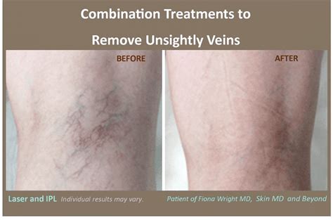 Using Lasers to treat Varicose and Spider Veins - BUTEX Medical spa and Laser treatment