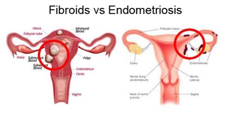 fibroid-vs-endometriosis | Fibroids, Endometriosis, Fibroids treatment