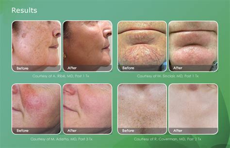 IPL Photofacial in Seattle WA - Advanced Dermatology and Laser Institute of Seattle