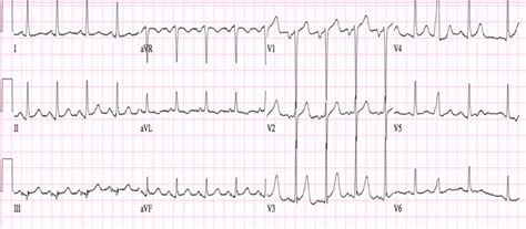 Left Atrial Enlargement