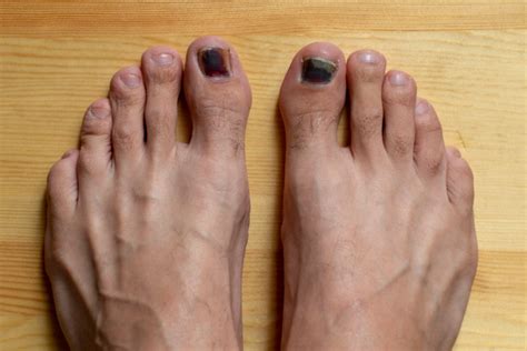 How to get rid of black toenail fungus [Stop black fungus under toenails]