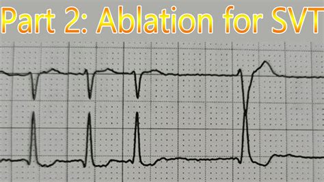 ABLATION for AVNRT-Supraventricular Tachycardia (SVT) and moving on. [Part 2] - YouTube