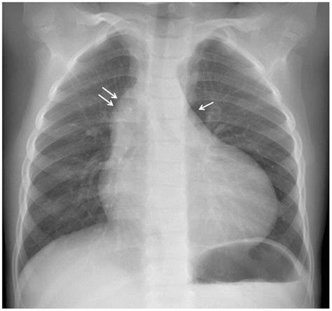 Chest X Ray Tortuous Aorta