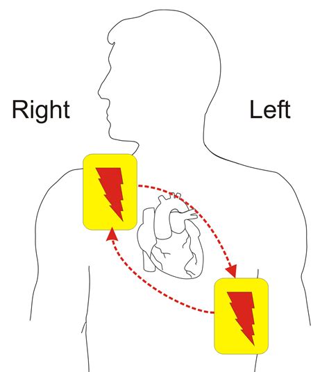 AED (Automated External Defibrillator) | CPR & First-Aid Training Class