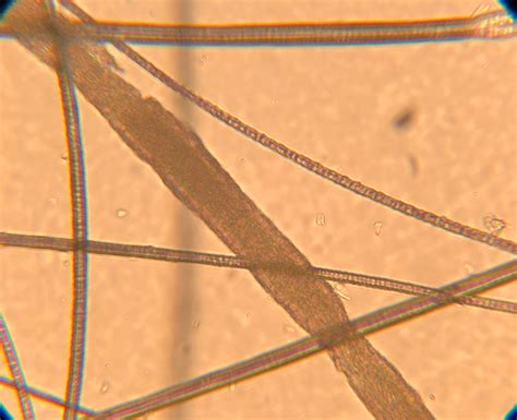 Dermatophytosis | Clinician's Brief