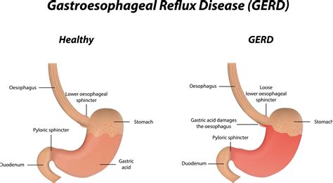 reflux esophagitis 醫學中文 – Davesies