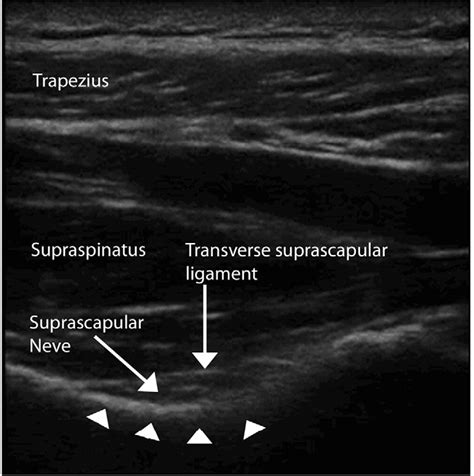 The Suprascapular Nerve Block - Sports Medicine Review