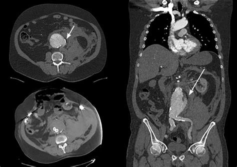 Abdominal Aortic Aneurysm AAFP, 55% OFF | www.gf-planen.de