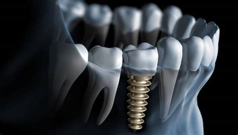 What happens in a dental implant procedure