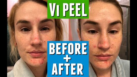 FIRST CHEMICAL PEEL: WHAT TO EXPECT | Vi Peel Review Before + After ...