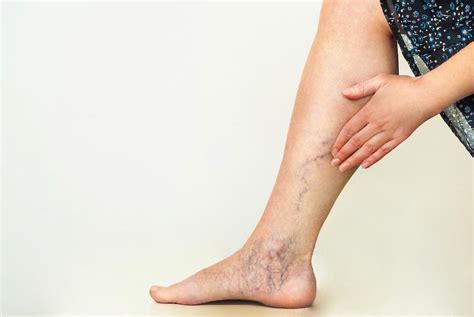 When Varicose Veins Are Symptomatic: Woodlands Heart and Vascular Institute: Cardiologists