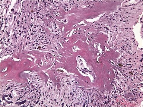 Osteoid Osteoma Histology