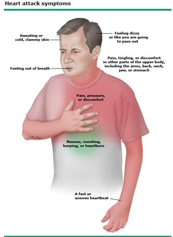 Ideal Cure...: Myocardial Infarction