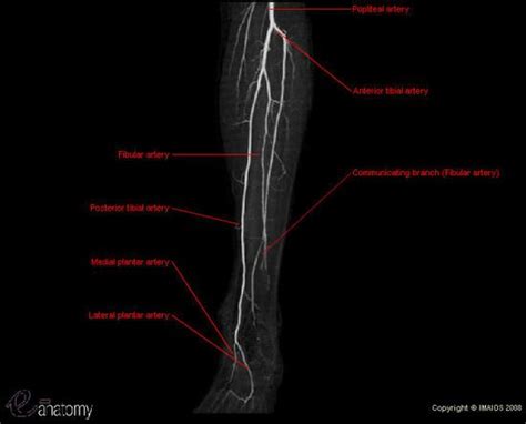 Normal arteriography of the leg : image adapted from MDCT (MIP) showing popliteal ,fibular ...