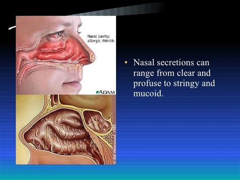 Allergic Rhinitis