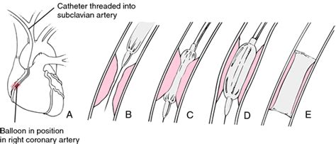 Percutaneous transluminal coronary angioplasty | definition of percutaneous transluminal ...