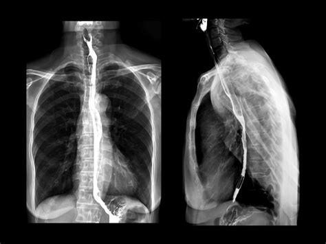 Immunotherapy Improves Survival in Advanced Esophageal Cancer - NCI