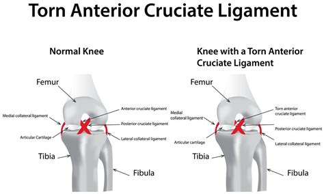 Anatomy Of The Anterior Cruciate Ligament (ACL) Injury