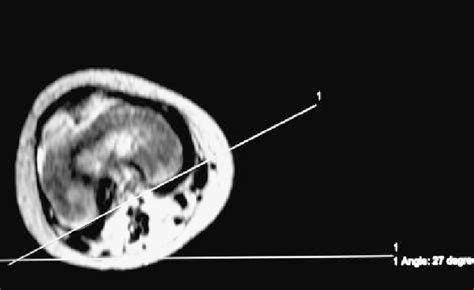 D.-T1-weighted MRI image of the left distal femur (normal side) of the ...