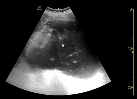 Emergency Physician-Performed Bedside Ultrasound of Gastric Volvulus | Cureus